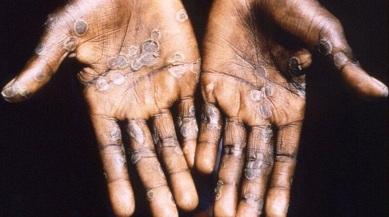 WHO: World faces big challenges over COVID, monkeypox and wars – Guyana Chronicle